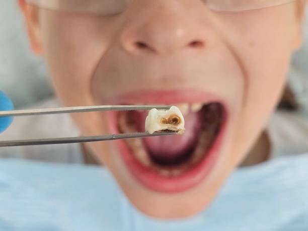 Best Emergency Wisdom Teeth Removal in Richmond, VA